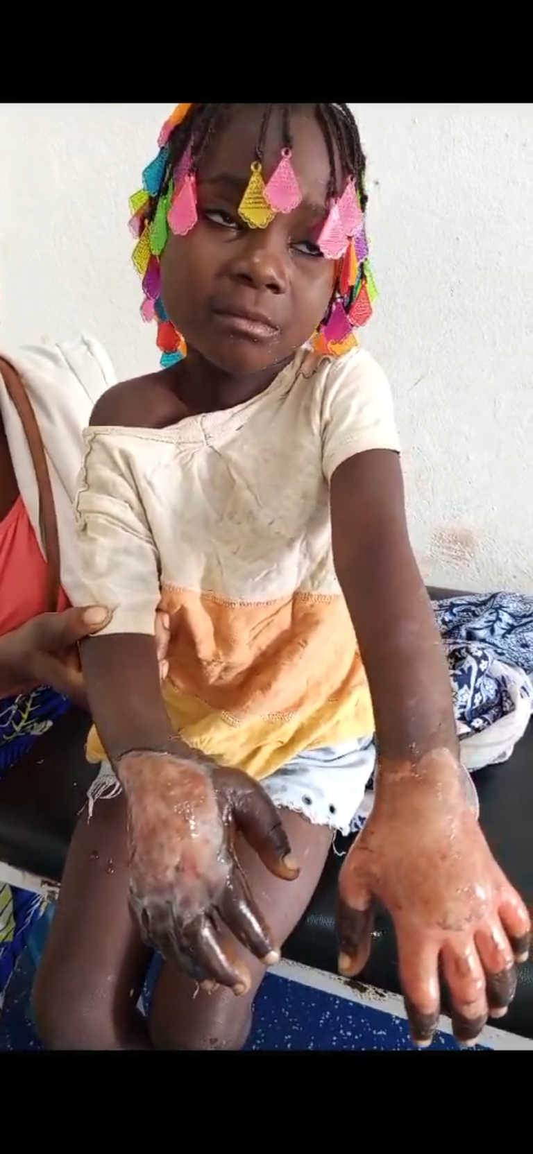LUANDA: PAI QUEIMA MÃOS DA SUA PRÓPRIA FILHA POR  TIRAR PEDAÇO DE SALSICHA NA ARCA