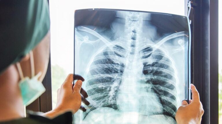 Casos de tuberculose continuam a aumentar em Luanda, alerta técnico de saúde